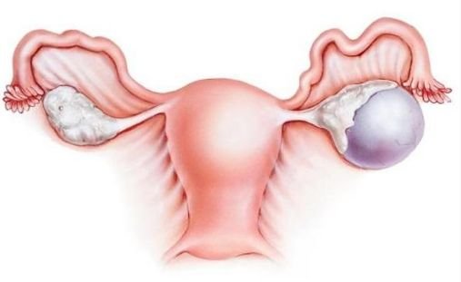 les-Kystes-ovariens